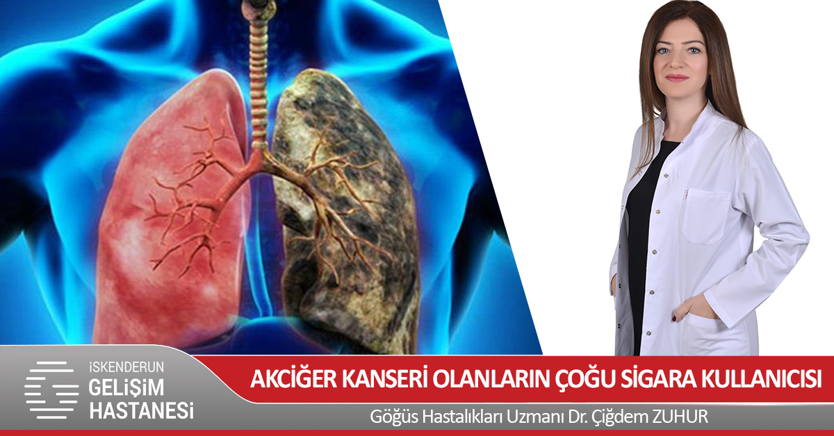 AKCİĞER KANSERİ OLANLARIN ÇOĞU SİGARA KULLANICISI
