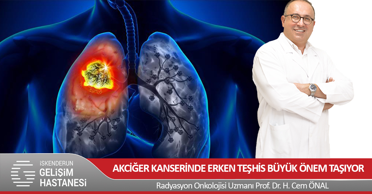 AKCİĞER KANSERİNDE ERKEN TEŞHİS BÜYÜK ÖNEM TAŞIYOR