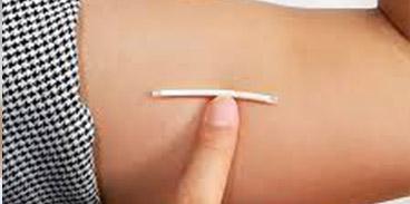 Deri Altı İmplant ile Doğum Kontrol Yöntemi