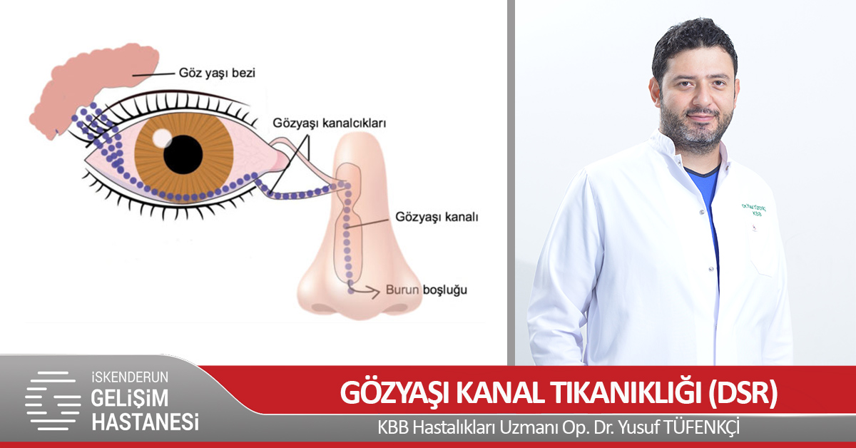 ENDOSKOPİK GÖZYAŞI KANAL TIKANIKLIĞI (DSR) AMELİYATI NEDİR?