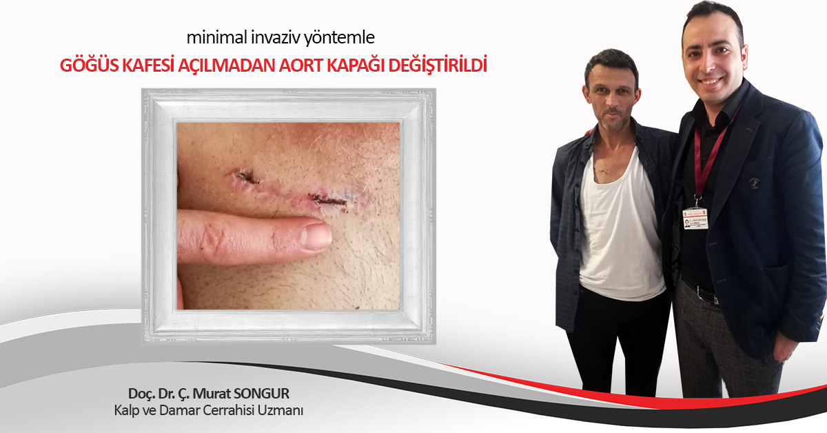 GÖĞÜS KAFESİ AÇILMADAN AORT KAPAĞI DEĞİŞTİRİLDİ