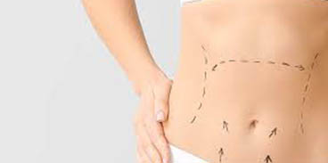 Karın Germe Ameliyatı Nedir?