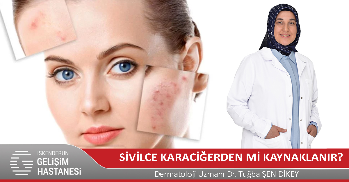 SİVİLCE KARACİĞERDEN Mİ KAYNAKLANIR?