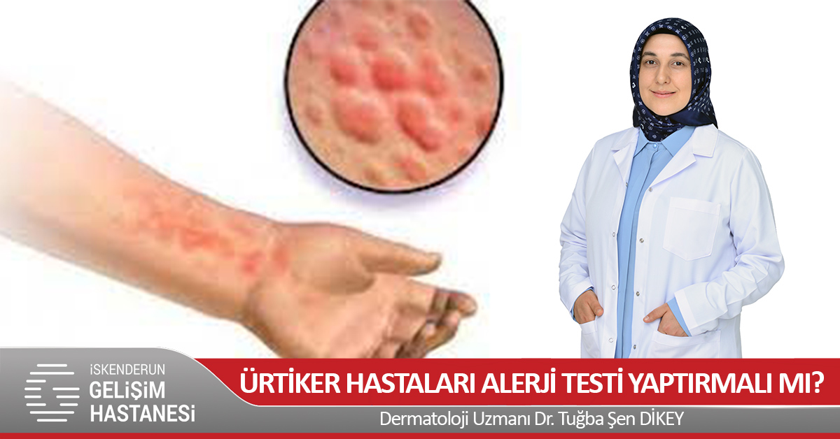 ÜRTİKER HASTALARI ALERJİ TESTİ YAPTIRMALI MI?